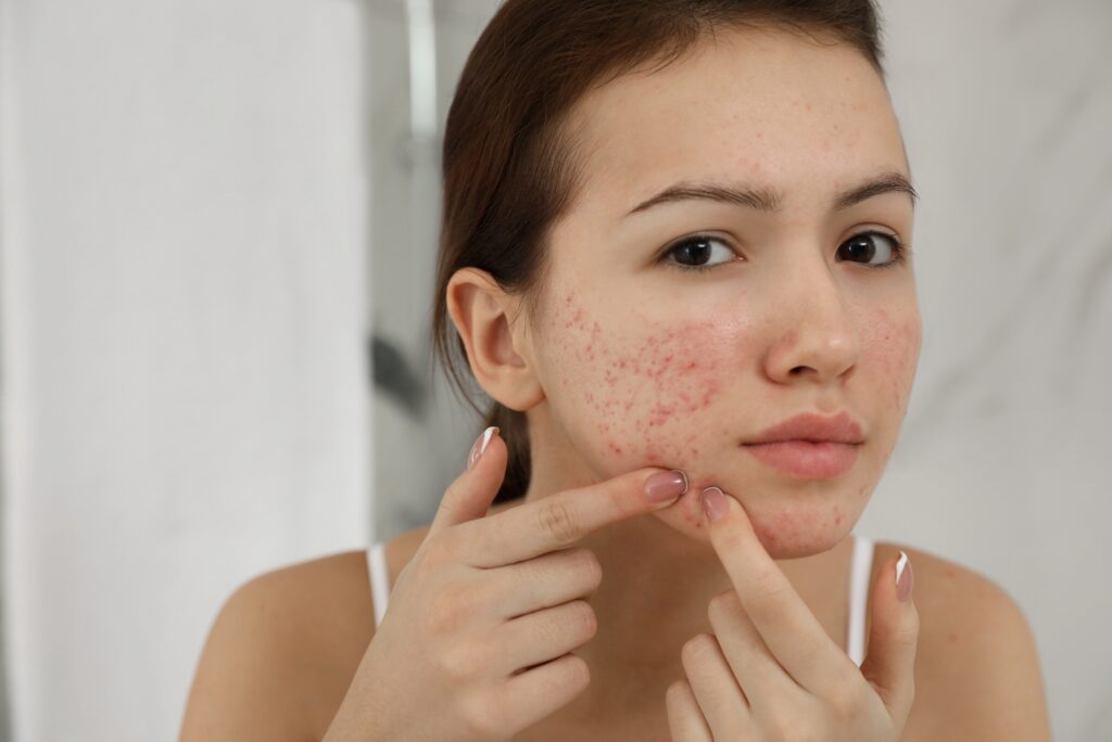Girl with Acne on face