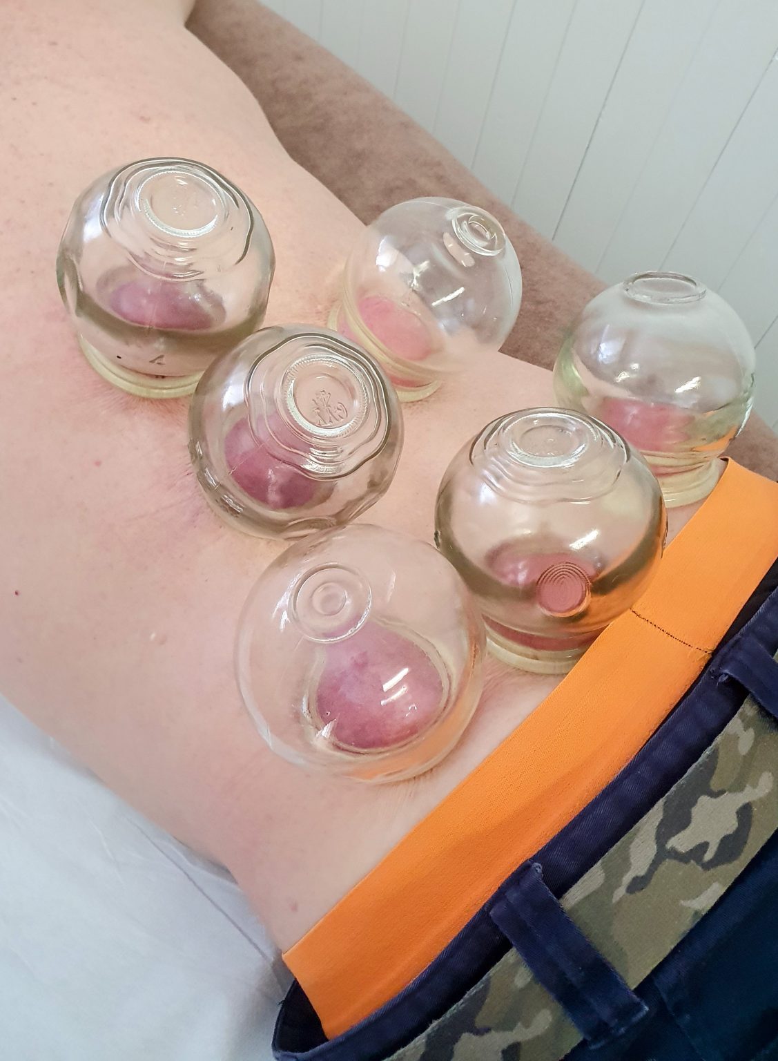 Clinic Gallery Why do we sometimes use Cupping Therapy in our treatments? Mackay Acupuncture