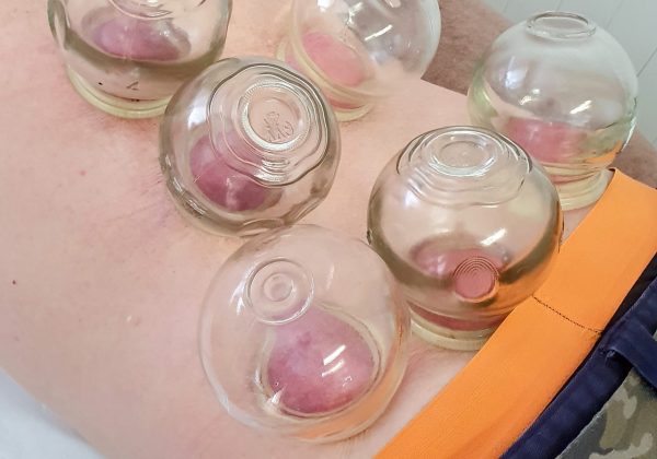 Cupping in Mackay clinic