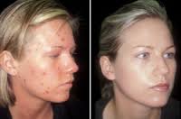 acne - Mackay Acupuncture Natural Medicine Mackay Acupuncture